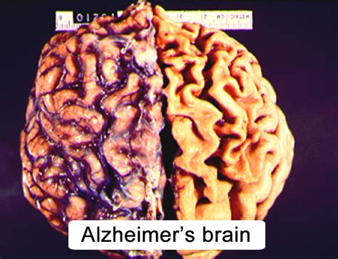 alzheimer's porn